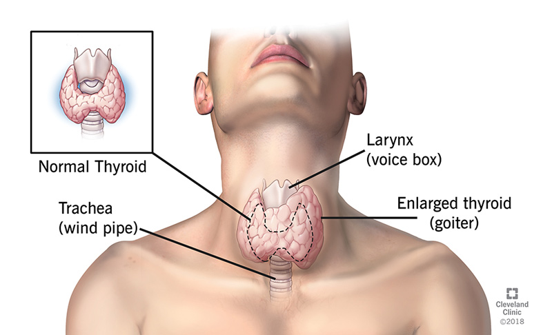 <p>Primary Hypothyroidism </p>