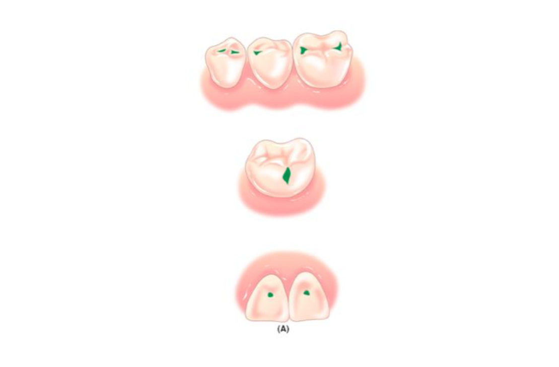 <p>Pits and fissures of anterior and posterior teeth. Buccal and lingual pits on the molars. Lingual pits inside the maxillary incisors( Anteriors teeth).</p>