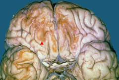 <p>What are microscopic features of a remote contusion?</p>