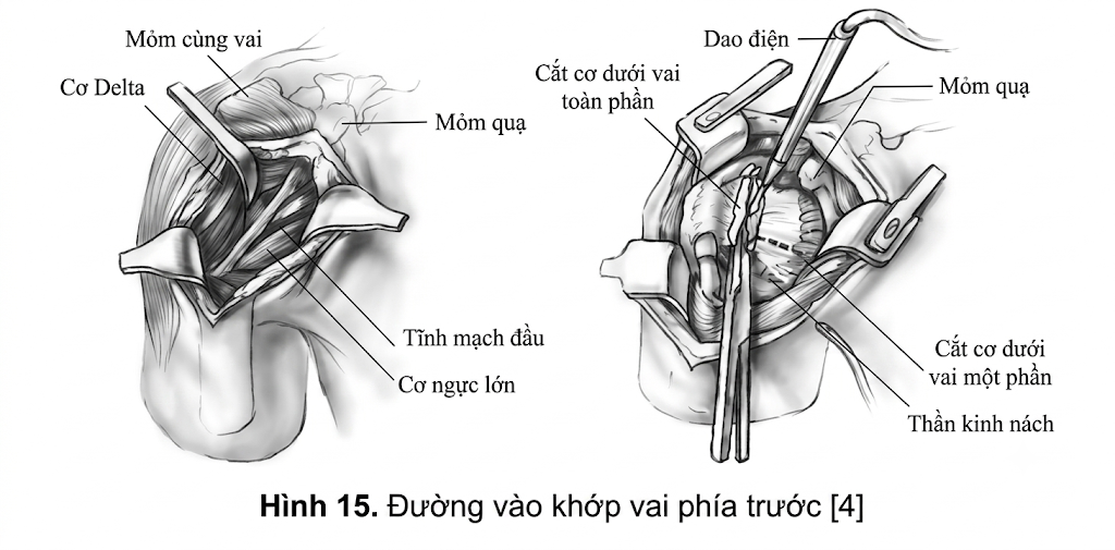 <p>Rạch da chiều dài khoảng 5- 8cm, từ vị trí bên dưới mỏm quạ 2cm -> mở rộng vết rạch xuống dưới dọc rãnh delta- ngực -> vẽn TM đầu ra ngoài cùng cơ delta + vén cơ ngực lớn vào trong -> mở mạc đòn ngực và cắt gân cơ dưới vai tại điểm bám -> bộc lộ bao khớp và cắt bao khớp theo hình chữ T (cạnh dọc chữ T đi giữa d/c ổ chảo cánh tay giữa- dưới)</p>