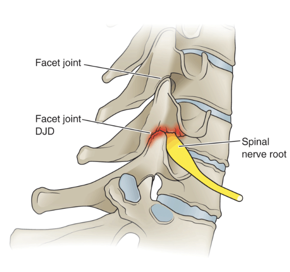 <p><em>(Frequently due to DDD {disc degenerative disease}) - Disc deteriorates & facets have to bear more weight → DJD </em></p><ul><li><p><strong>Pain</strong> :</p><ul><li><p>Localized : Neck to scapular region</p></li></ul></li><li><p><strong>Causes</strong> : aging & obesity </p></li><li><p><strong>Symptoms</strong> : Pain that worsens with extension (could lead to cervicogenic headache) = limited extension ROM</p><img src="https://assets.knowt.com/user-attachments/1b12066d-78cc-4018-9cd8-113b317fb8c3.png" data-width="100%" data-align="center"></li></ul><p></p>