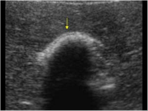 <p>Name findings. What is a normal pitfall?</p>