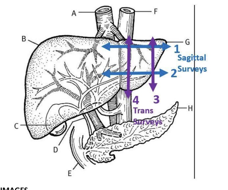 <p>Turn to transverse now and place the probe at the lateral edge of the liver. Keeping the lateral edge of the left lobe on the screen at all times, slide inferiorly until about 2 cm below the liver and begin survey by sweeping superiorly past the level of the diaphragm, and returning inferiorly to the starting postion below the liver.</p><p>Slide the probe towards the patients the patients midline and ensure the great vessels (Ao/IVC) are centred in the screen. Move the probe inferiorly until about 2 cm below the level of the liver. Sweep superiorly keeping the great vessels centred on the screen, until above the level of the diaphragm and then inferiorly to starting postion 2 cm below the liver.</p>