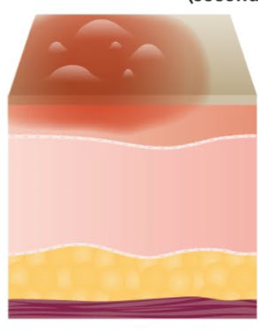 <p>Superficial thickness Second Degree burn?</p>