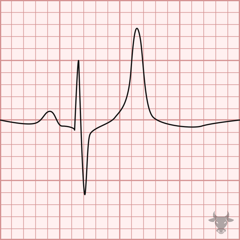 <p>Identify the electrolyte imbalance based on the ECG: </p><ul><li><p>Peaked T wave</p></li><li><p>Wide QRS complex</p></li><li><p>Flat P wave</p></li></ul><p></p>