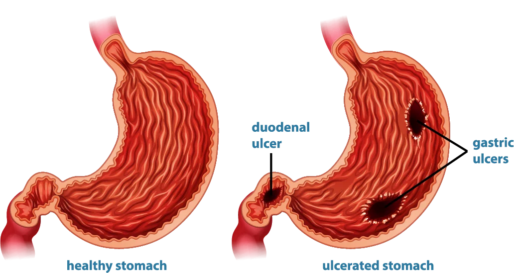 <p><span style="line-height: 107%;"><strong>BOOK:</strong></span></p><p class="MsoNormal"><span>Hole in the lining of the stomach or duodenum<strong>.</strong></span></p><p class="MsoNormal"><span style="line-height: 107%;"><strong>SIMPLE:</strong></span></p><p class="MsoNormal">A condition in which <span style="font-family: Calibri, sans-serif;">open sores (ulcers) develop in the lining of the stomach or the first part of the small intestine</span>.</p>