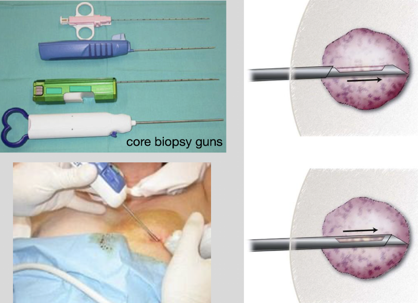 <ul><li><p>uses a <span style="color: yellow;">14-20G needle </span>(larger than FNA)</p></li></ul><ul><li><p>uses a spring-loaded biopsy gun to obtain a core (small cylinder) of tissue for histologic analysis</p></li><li><p>when the biopsy gun is fired:</p><ul><li><p>the cutting needle rapidly advances (“throws” forward),</p></li><li><p>cuts a tissue sample,</p></li><li><p>and stores the specimen in the “deposit slot” on the inner needle</p></li></ul></li><li><p>“throw length” refers to the…</p><ul><li><p>distance the needle advances when fired, and</p></li><li><p>length of the tissue specimen obtained</p></li></ul></li><li><p>pay attention to how many “throws” (count them)</p></li></ul><p></p>