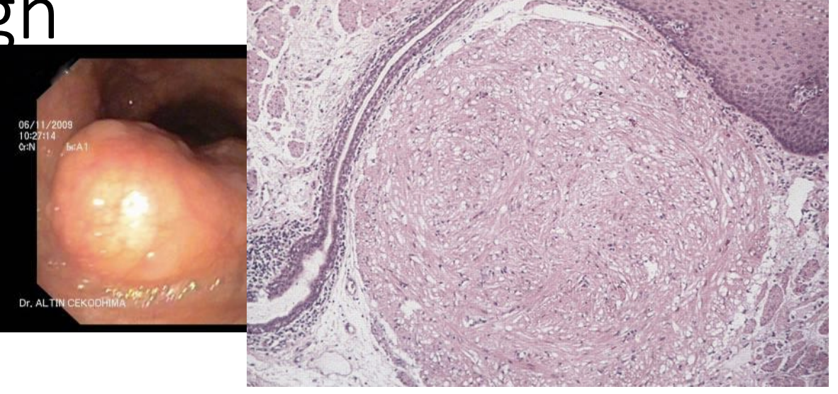 <p>diagnosis, esophageal tumor</p>