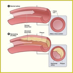 <p>coronary artery disease</p>