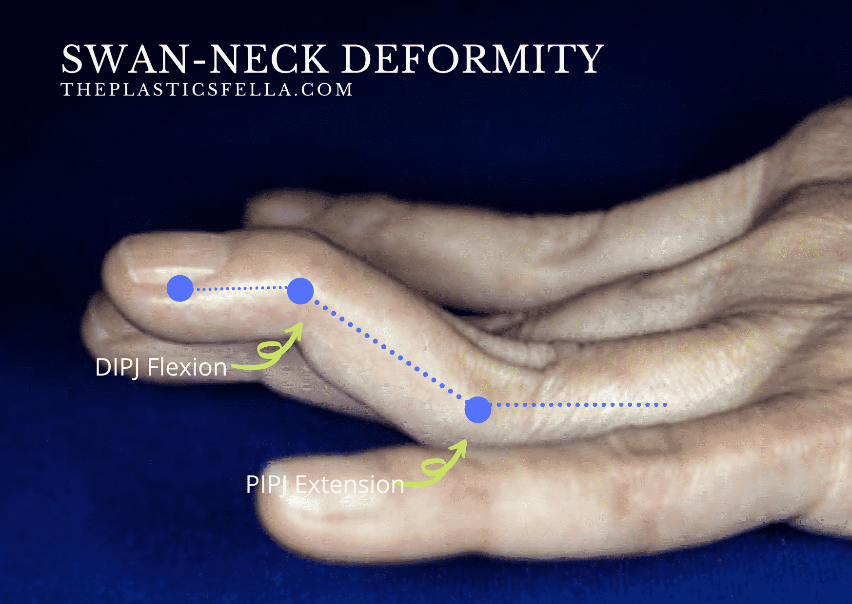 <ul><li><p>providing 3-point pressure system: prevents PIP (middle) joint from hyperextending</p></li><li><p>By positioning the oval band on top of the finger, they restrict backward bending + allows flexion &amp; maintaining DIP joint extension.</p></li></ul><p></p>