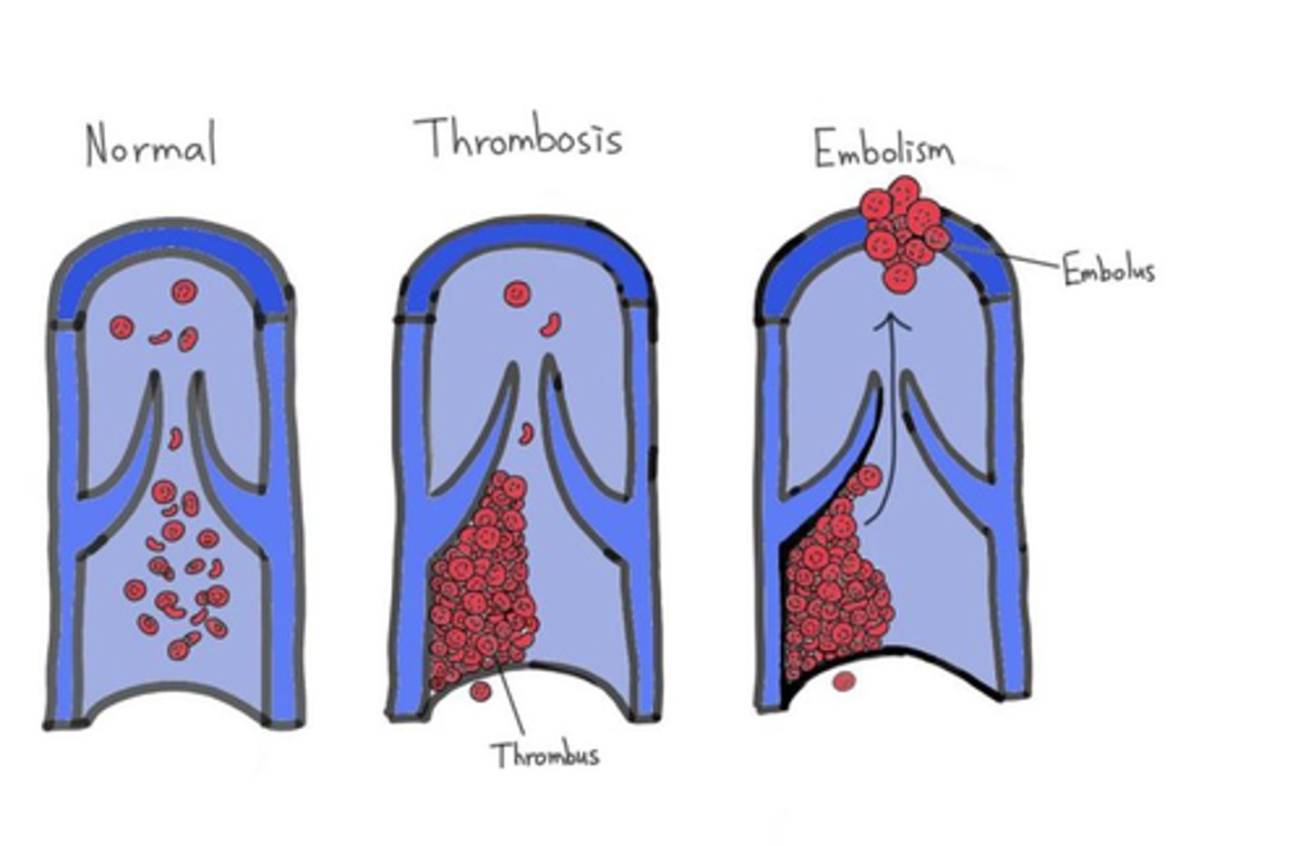 <p>A) Thrombi are blood clots that form in a vein or artery and stay in place, while emboli are blood clots that travel through the bloodstream to another location.</p>