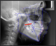 <p>which anatomical landmark:</p><p>- The inferior alveolar nerve canal</p><p>- Used to superimpose the mandible</p>