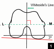 <p>Anteroposterior trochlear axis used as a secondary check for femoral rotation.</p>
