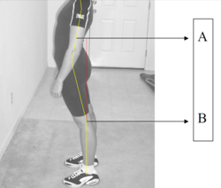 <p>What Spinal Curvuture?</p>