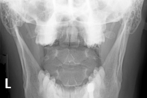 <p>C-Spine Odontoid: Which options are true?</p><ol><li><p><span>A repeat with more flexion of the head/neck is needed</span></p></li><li><p><span>A repeat with more extension of the head/neck is needed</span></p></li><li><p><span>The R/L marker is incorrect</span></p></li><li><p><span>This is a well-positioned radiograph; no repeat required.</span></p></li></ol><p></p>