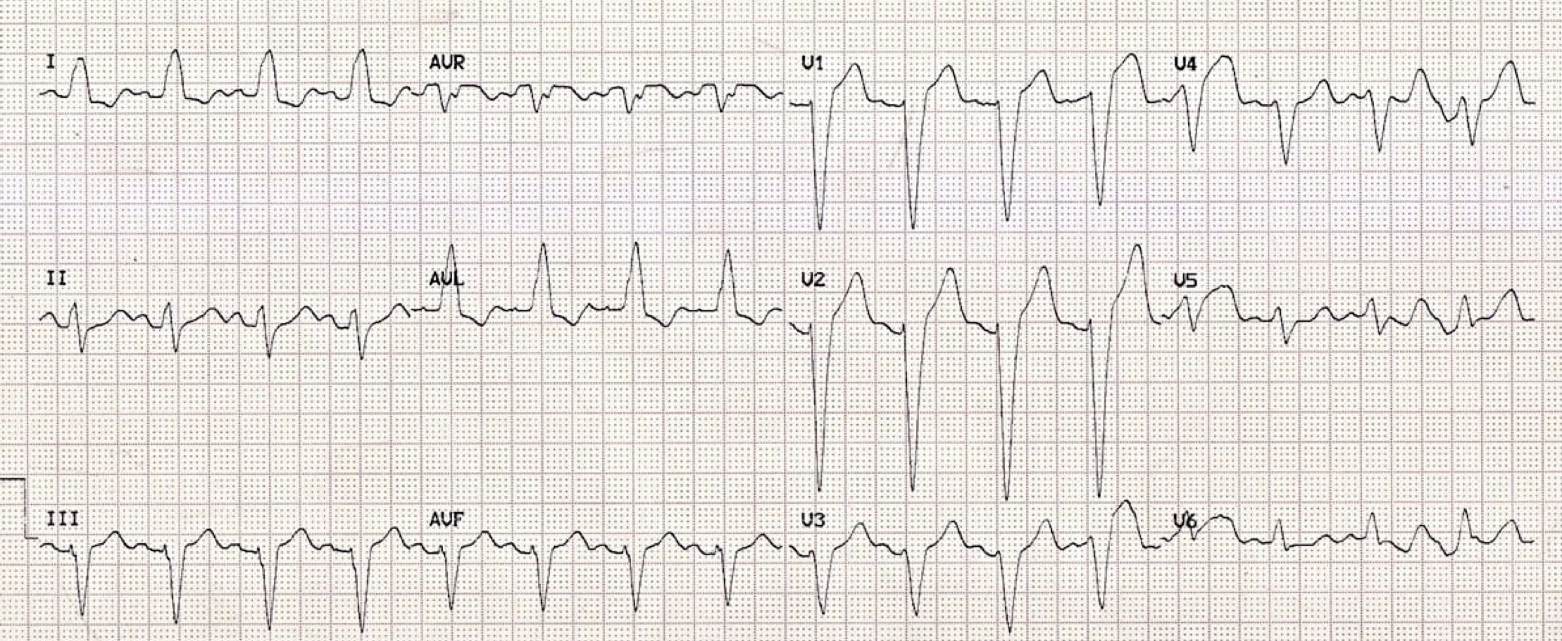 <p>What rhythm/abnormality is seen below?</p>