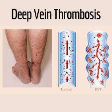 <p>The formation of a blood clot inside a blood vessel, which can block blood flow.</p>