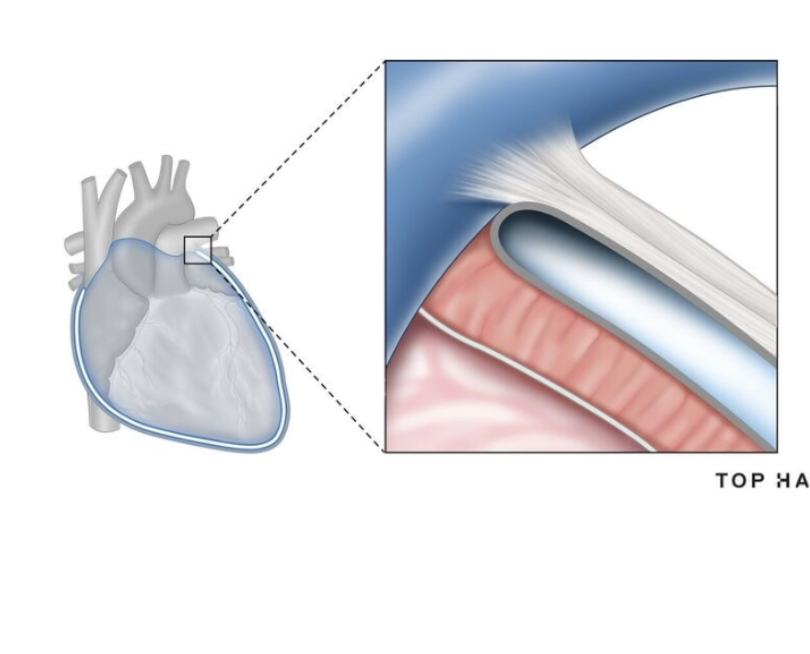 <p>the layers of the pericardial sac from superficial to deep</p>