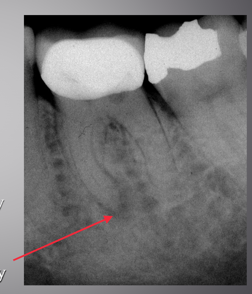 <ul><li><p><strong>Percussion: + to +++</strong> → indicates <strong>inflammation of the periodontal ligament</strong>, causing pain when the tooth is tapped.</p></li><li><p><strong>Bite: + to +++</strong> → suggests inflammation around the root/apical tissues; biting pressure aggravates the inflamed periodontal ligament.</p></li><li><p><strong>Cold: −</strong> → no response to cold, which strongly suggests <strong>pulp necrosis</strong> (assuming the test was performed correctly and compared with control teeth).</p></li><li><p><strong>Heat: −</strong> → also supports loss of pulpal vitality.</p></li><li><p><strong>Radiographic evidence of apical periodontitis: frequent</strong> → inflammation at the root apex may be visible radiographically.</p></li><li><p><strong>Periapical radiolucency: may or may not be present</strong> → an early apical inflammatory lesion can exist <strong>before a radiolucency becomes detectable</strong> on a conventional radiograph.</p></li></ul><p></p>