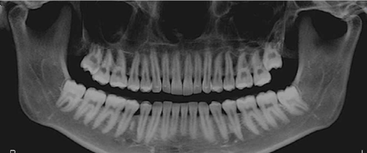 <p>panoramic view of both upper and lower jaw</p>