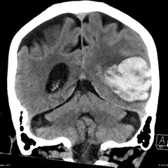 <p>What are the features of intraparenchymal hemorrhage due to cerebral amyloid angiopathy?</p>