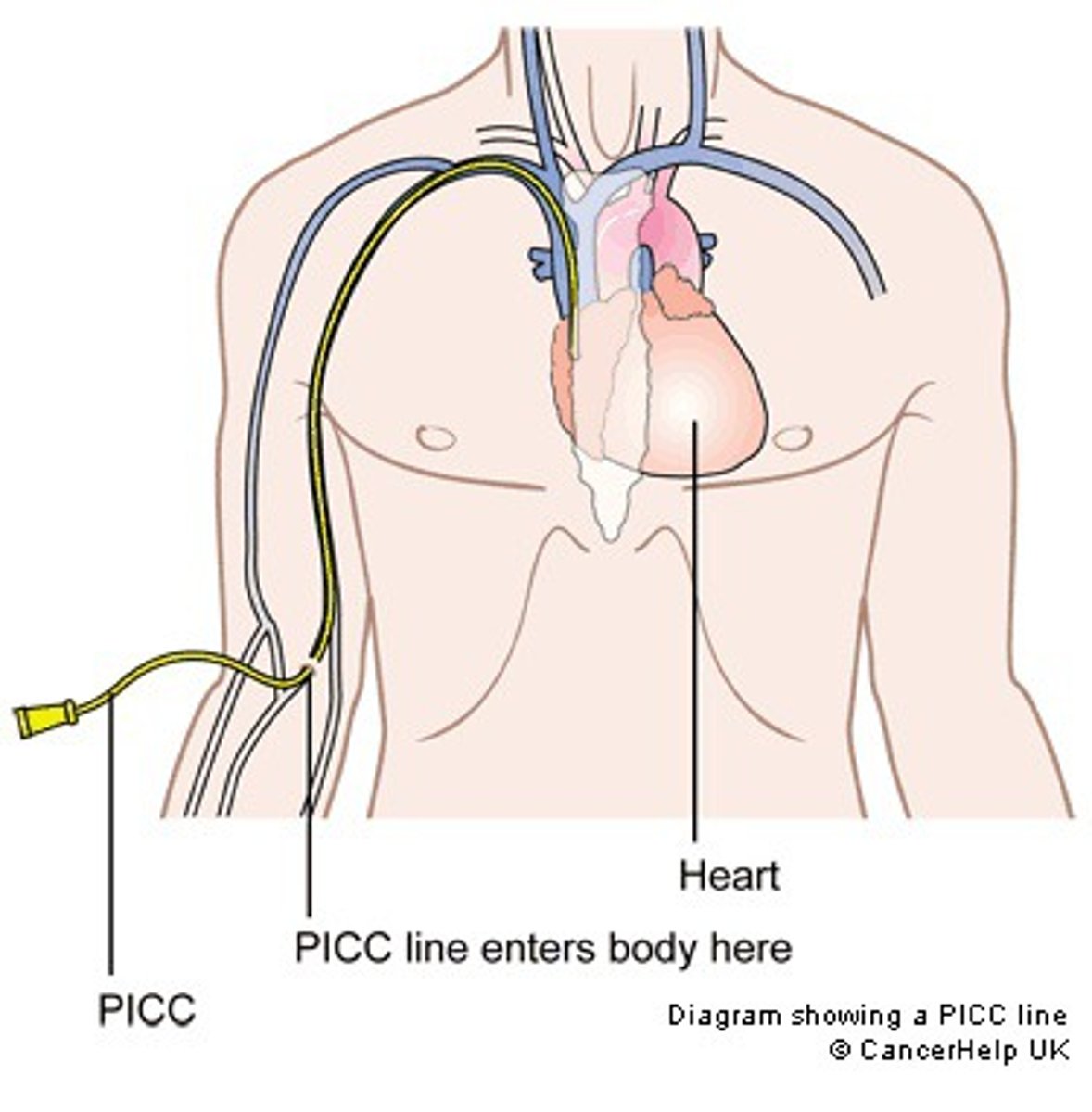 <p>catheter inserted into vein in upper arm for long-term medications/fluids</p>