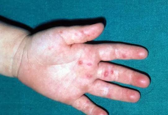 <p>how does <strong>hand, foot, and mouth disease</strong> spread? *</p>