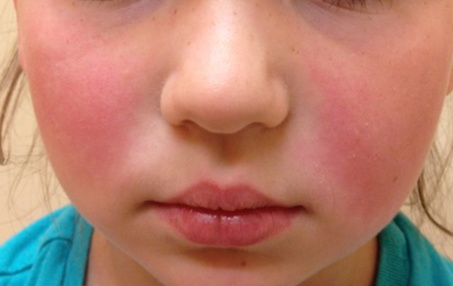 <p>Causative Agent: Parvovirus B19<br>Symptoms/Signs: “Slapped Face” rash which spreads to the body but remains most prominent on the extremities and trunk.</p>