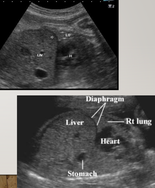 <ul><li><p>large compared to other abdominal organs</p></li><li><p>occupies upper right abdomen</p></li><li><p><span style="color: red;">left lobe is larger in utero</span></p></li><li><p>SONO:</p><ul><li><p>homogeneous, moderate echogenicity</p></li><li><p>helpful for determining situs and obtaining AC measurement</p></li></ul></li></ul><p></p>