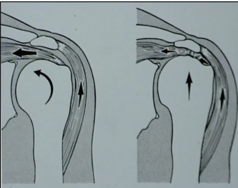 <ul><li><p><span>Humeral head moves superiorly due to:</span></p><ul><li><p><span>Weakening of rotator cuff pull medially</span></p></li><li><p><span>Deltoid pull superiorly</span></p></li></ul></li></ul><p></p>