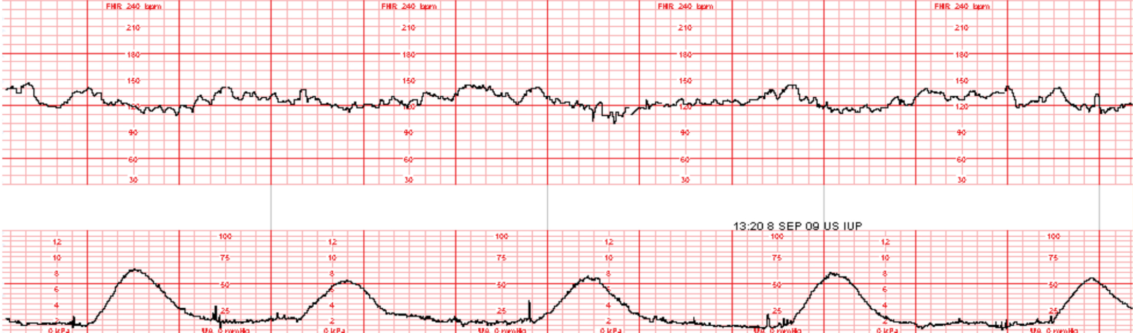 <ul><li><p>abt 12 min strip </p><ul><li><p>5 contractions </p></li></ul></li><li><p>normal!</p></li></ul><p></p>