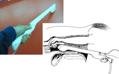 <p>This mechanism of twin reduction is invasive, typically a last ditch effort after 35 days, or at least after fixation</p>