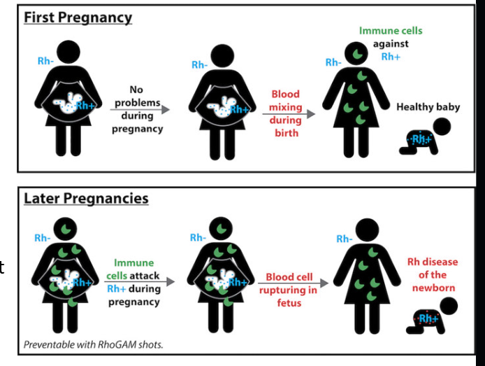 <p><strong>Blood Typing (cont.) — Pregnancy &amp; Rh</strong></p><ul><li><p>Is this usually an issue during the first pregnancy?<br></p></li><li><p>What happens if the baby has an antigen that the mother doesn't?</p><p class="font-claude-response-body break-words whitespace-normal"></p></li></ul><p></p>