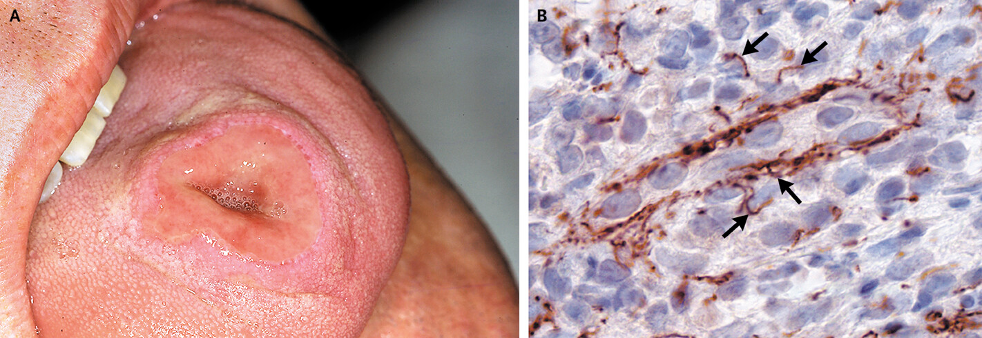 <p><span>occurs about <strong>3 weeks after infection</strong> and consists of a painless, red ulcer with a hard rim called a hard <u>chancre</u> that appears at the site of infection. The chancre is often hidden from view in women and homosexual men. Local lymph nodes enlarge.</span></p>