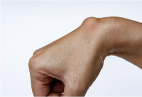 <ul><li><p>Benign </p></li><li><p>Can be recurrent </p></li><li><p>Encapsulated </p><ul><li><p>Can be loculated </p></li></ul></li><li><p>Usually filled with joint fluid </p></li><li><p>Usually from overuse/activity/inflammation </p></li><li><p>Can feel hard or firm </p></li><li><p>Can restrict movement </p></li><li><p>Usually leave alone if causing no symptoms </p></li></ul><p></p>