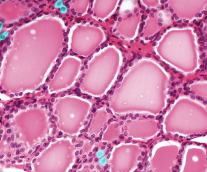 <p>parafollicular (C) cells </p>
