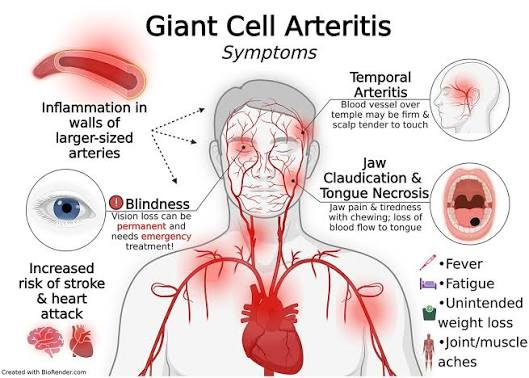 <p><strong>Answer:</strong><br><strong>C) Arterial inflammation</strong></p><p class=""><strong>Diagnosis:</strong><br><strong>Giant cell arteritis associated with polymyalgia rheumatica</strong></p><p> Mechanism </p><p>Granulomatous inflammation affects medium and large arteries, including branches of the carotid artery. Inflammation narrows or occludes the <strong>posterior ciliary arteries</strong>, reducing blood flow to the optic nerve and causing <strong>arteritic anterior ischemic optic neuropathy</strong> with sudden permanent vision loss.</p><p> Key clues </p><ul><li><p>Age <strong>>50</strong></p></li><li><p>New headache and tender temporal area</p></li><li><p>Fever, fatigue, weight loss</p></li><li><p>Shoulder and neck aching → <strong>polymyalgia rheumatica</strong></p></li><li><p>Very high ESR</p></li><li><p>Sudden monocular vision loss</p></li></ul><p> Why not arterial embolization? </p><p>An embolus can cause sudden monocular blindness, but it would not explain the preceding weeks of temporal headaches, constitutional symptoms, shoulder aching, temporal tenderness, and markedly elevated ESR.</p><p> Immediate management </p><p>Give <strong>high-dose glucocorticoids immediately</strong>—with visual loss, typically IV methylprednisolone—before waiting for temporal artery biopsy. Treatment is urgent to prevent blindness in the other eye.</p><p><strong>Flashcard rule:</strong><br><strong>Older patient + headache + temporal tenderness + PMR symptoms + high ESR + vision loss → giant cell arteritis from arterial inflammation.</strong></p>