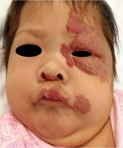 <p><span>Proliferación vascular benigna de células endoteliales en la infancia.</span></p>