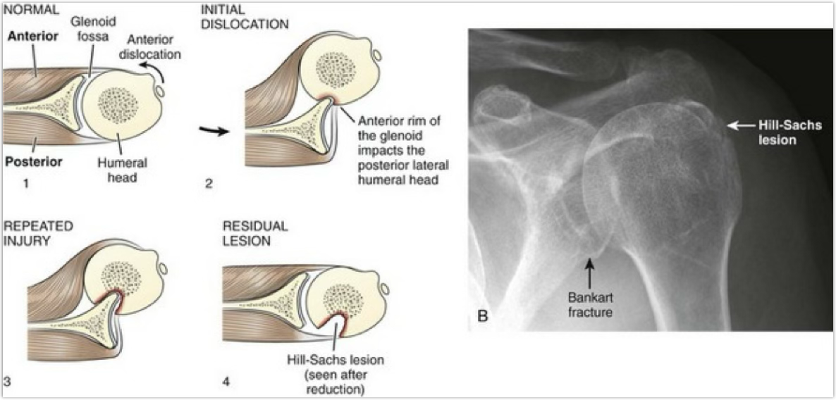<p>bankart lesion</p>