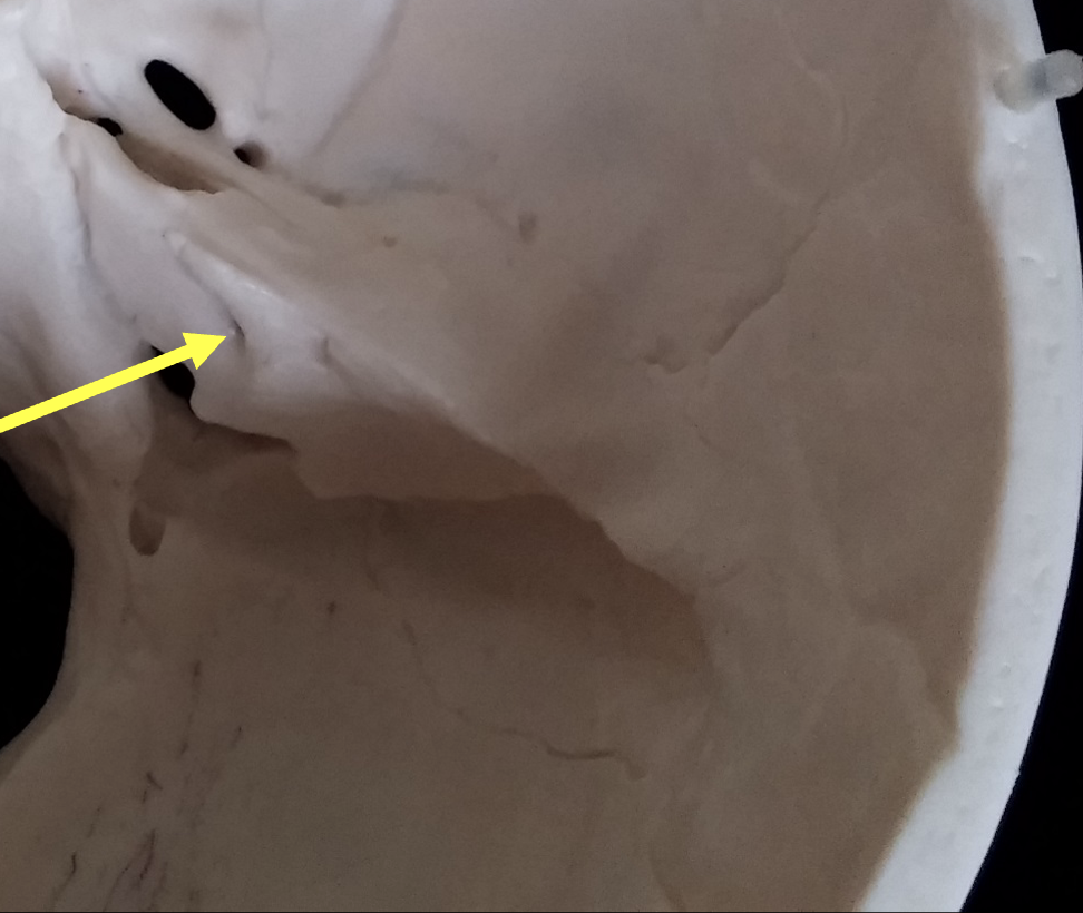 <p>What is the bone indicated by the arrow on the temporal bone?</p>
