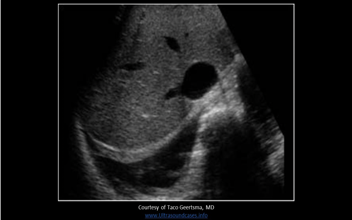 <p>Where is free fluid documented on the image?</p><p>A. pleural space</p><p class="p1">B. subphrenic space</p><p class="p1">C. subhepatic space</p><p class="p1">D. paracolic gutter</p>