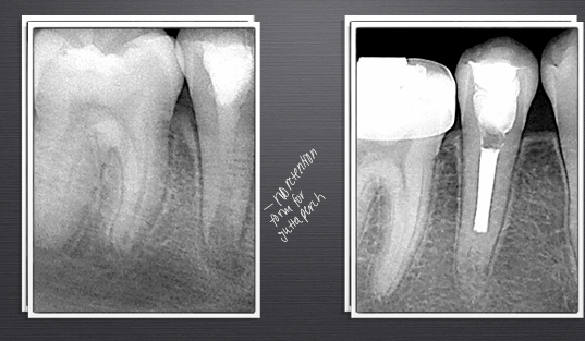 <p>-a method to induce a calcified barrier in an immature root with a necrotic pulp</p><p>-place calcium hydroxide → promotes cells in PA space to grow in from the bottom, will get barrier to form at apex</p><p>-change calcium hydroxide a couple times, will require recall</p>