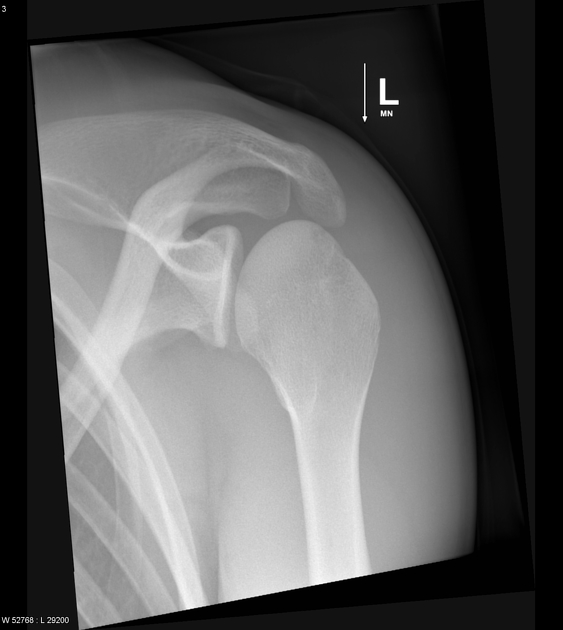 <p>correct rotation is evidenced by coracoid process is projected over part of elongated humeral head, acromion and ac joint are superior to humeral head </p>