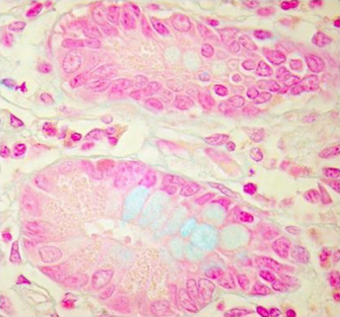 <p>washing well after counterstaining</p><p>Feedback:</p><p>The alcian blue solution is most likely depleted or weakened, and should be replaced. It should have a pH of 2.5 and sections should be well-hydrated. Although washing well after nuclear fast red counterstaining is necessary, it is not the problem seen in this section.</p>