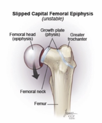 <p>CC: Vague hip, groin, thigh, knee pain</p><p>- Can be atraumatic (more common)</p><p>- Can be traumatic after a fall or while playing sports</p><p>- Primary caregiver notices a limp</p>