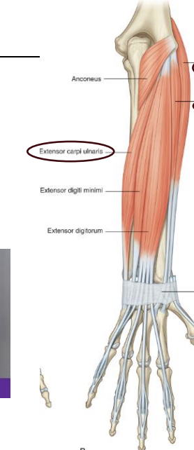 <p><strong>Posterior Forearm Muscle- </strong>Extensor carpi ulnaris (ECU)</p>