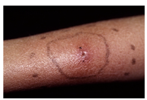 <p>To monitor the spread or improvement of infection.</p>
