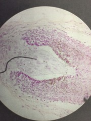 <p>Invagination</p>