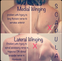 <p>ACCESSORY NERVE</p><p>note this is describing LATERAL winging which will be accessory nerve damage</p>