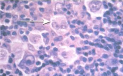 <p>Hodgkin's lymphoma에서 발견되는 다음과 같은 (화살표) 올빼미 눈 모양의 특징적인 세포는?</p>